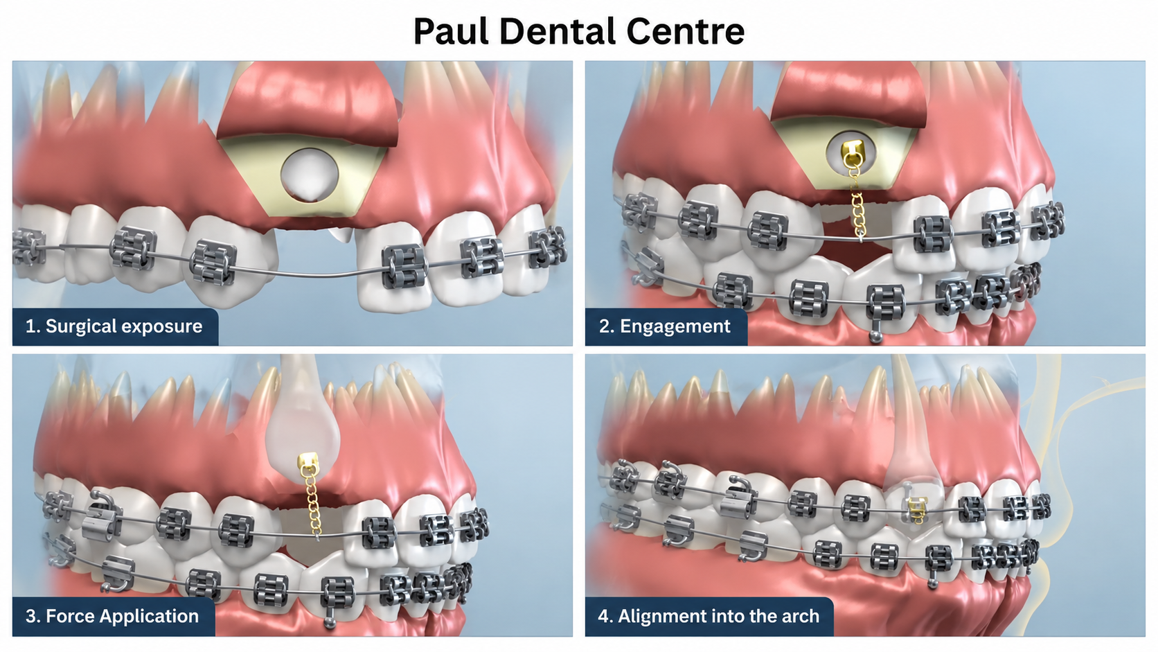 Surgical Management of Impacted Teeth